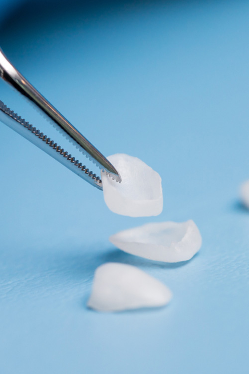 Veneers Cover Dental Imperfections Flawlessly